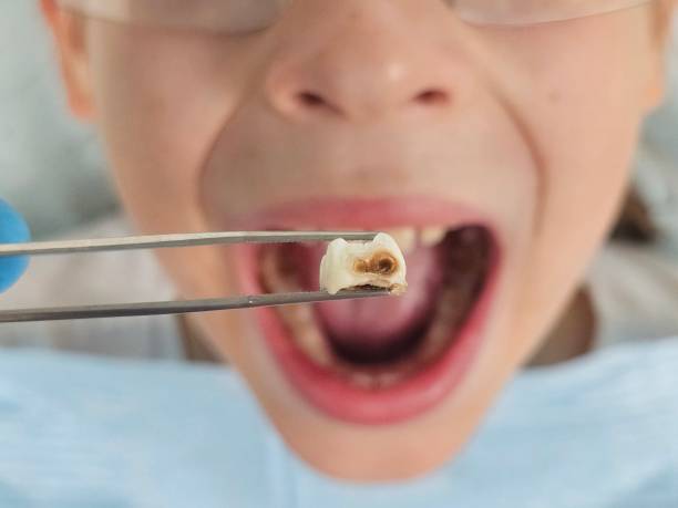 Best Emergency Wisdom Teeth Removal in Rossvle, IL